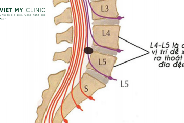 Những điều cần biết về đốt sống lưng L4&L5: Nguyên nhân & cách điều trị.