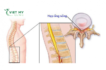 Hẹp ống sống – Căn bệnh không thể xem thường. Nguyên nhân và giải pháp điều trị an toàn hiệu quả