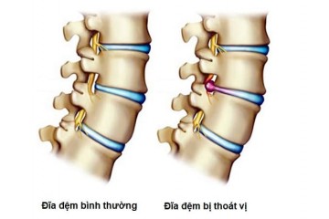 TRƯỢT ĐỐT SỐNG L4 L5 VÀ NHỮNG ĐIỀU CẦN BIẾT