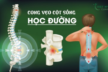 CONG VẸO CỘT SỐNG HỌC ĐƯỜNG - TÌNH TRẠNG ĐÁNG BÁO ĐỘNG HIỆN NAY