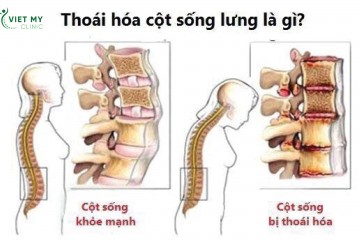 KHÁM CỘT SỐNG THẮT LƯNG VÀ NHỮNG ĐIỀU CẦN BIẾT NHẤT