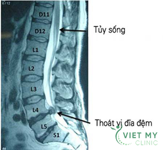 hinh-anh-thoat-vi-dia-dem-cot-song-that-lung-mri
