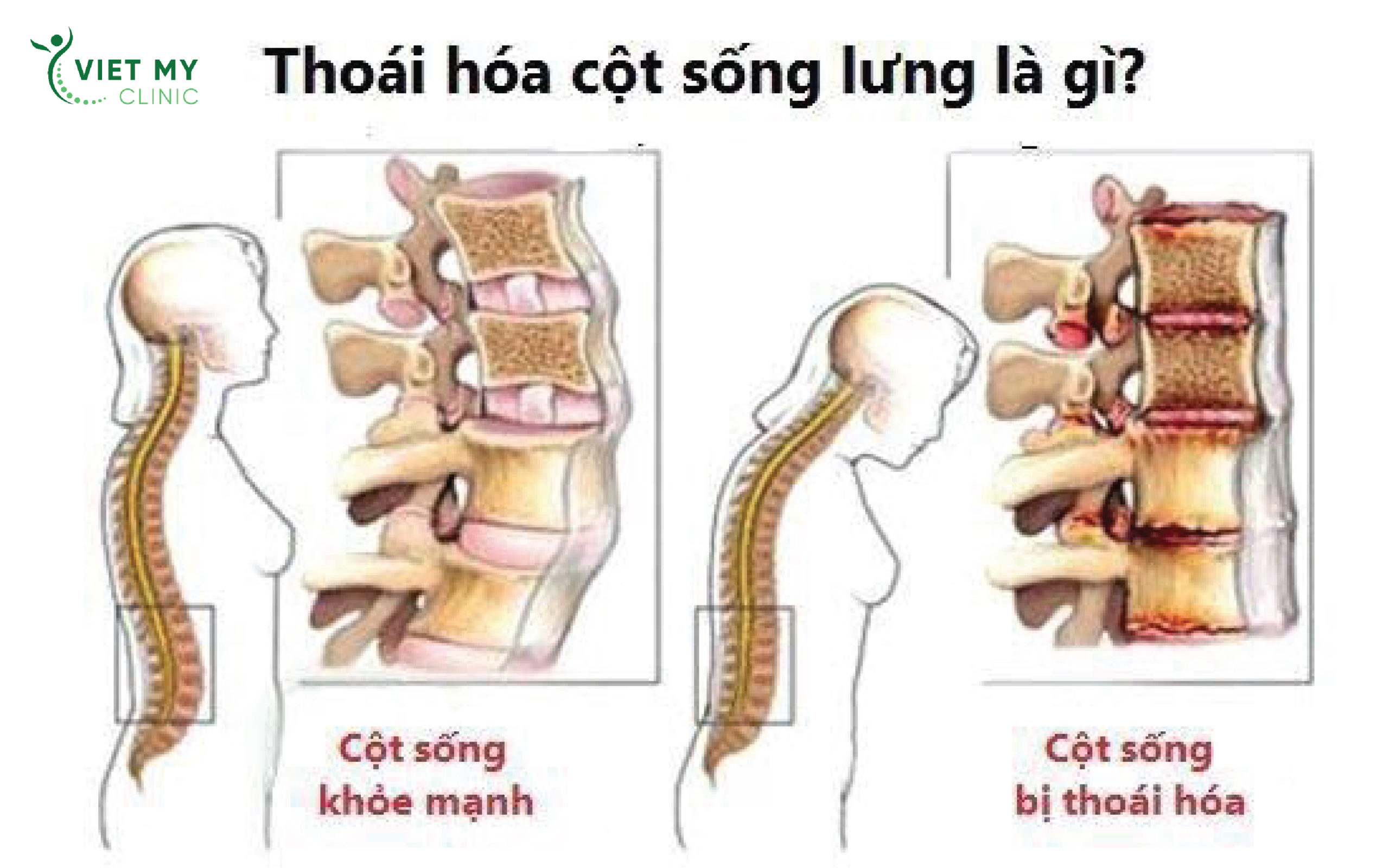 4. Bài Tập Hỗ Trợ Cột Sống Thắt Lưng