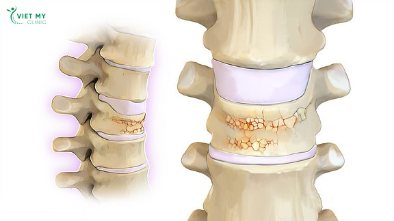 Làm thế nào để bảo vệ cột sống khi bị loãng xương?